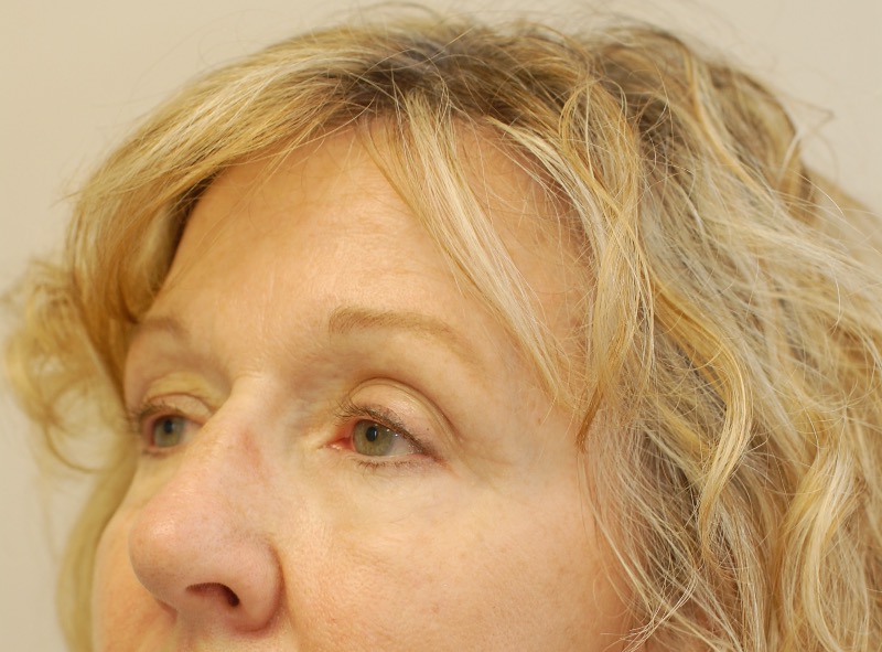 Tear trough under eye treatment 